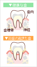 健康な歯と炎症の起きた歯の比較
